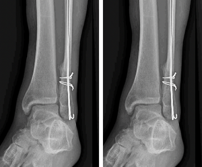 Fracture de la cheville H pital DCSS